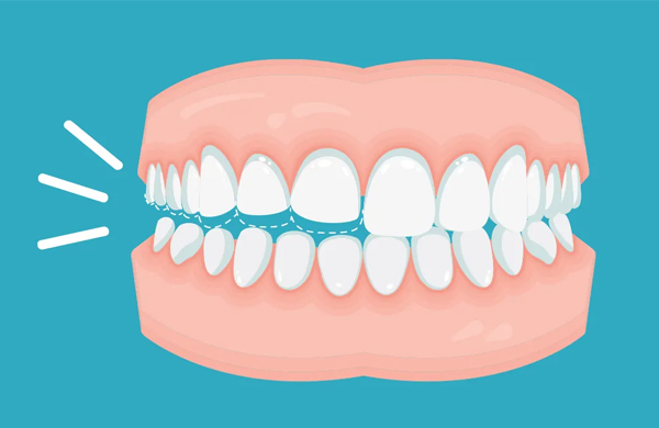 Bruxismo do sono - saiba como evitar as dores e desgastes dos dentes