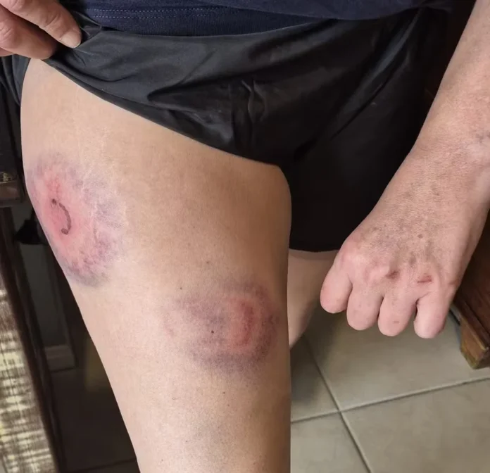 suplente-ao-senado-e-derrubada-chutada-e-atingida-por-bala-de-borracha-pela-pm-em-sc-video.webp